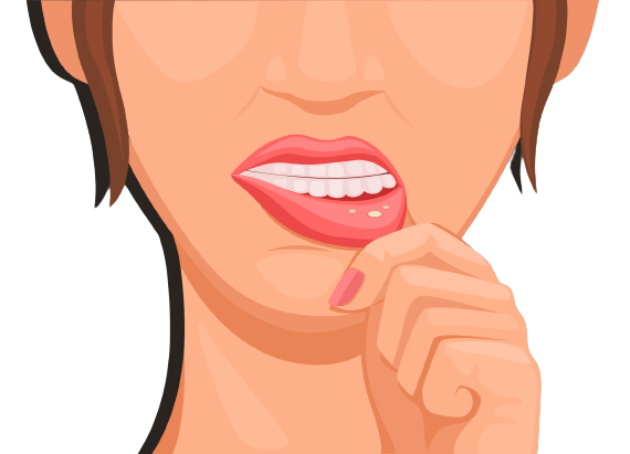 Woman with canker sores